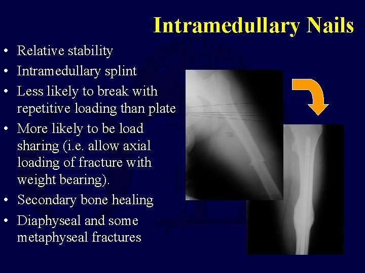 Intramedullary Nails • Relative stability • Intramedullary splint • Less likely to break with