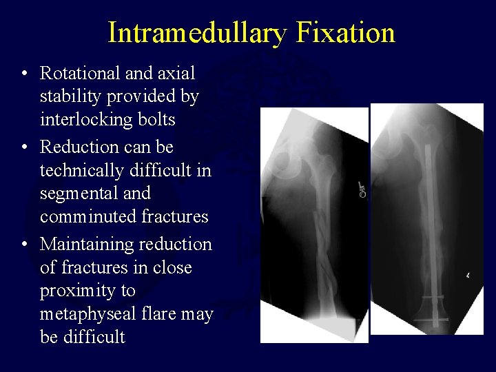 Intramedullary Fixation • Rotational and axial stability provided by interlocking bolts • Reduction can
