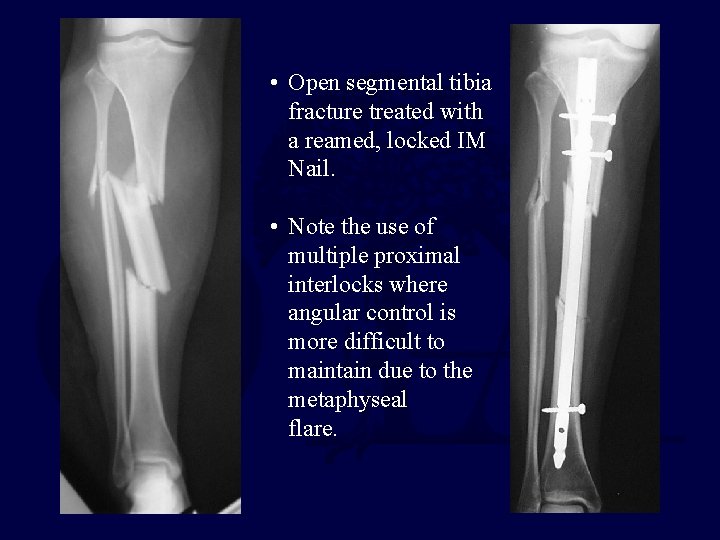 • Open segmental tibia fracture treated with a reamed, locked IM Nail. •
