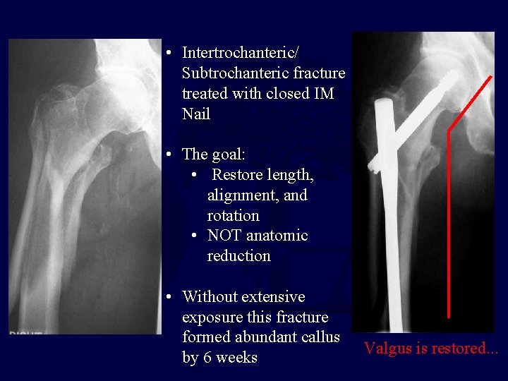  • Intertrochanteric/ Subtrochanteric fracture treated with closed IM Nail • The goal: •
