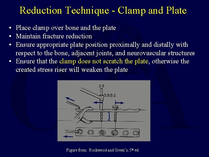 Reduction Technique - Clamp and Plate • Place clamp over bone and the plate