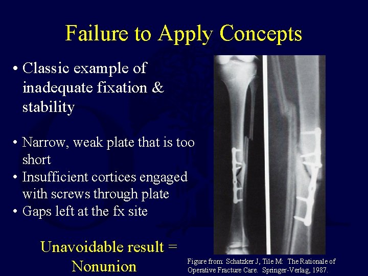 Failure to Apply Concepts • Classic example of inadequate fixation & stability • Narrow,