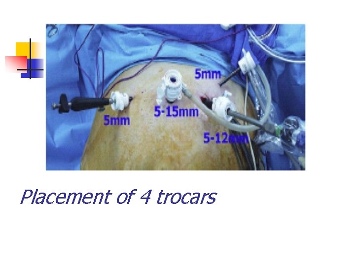 Placement of 4 trocars 