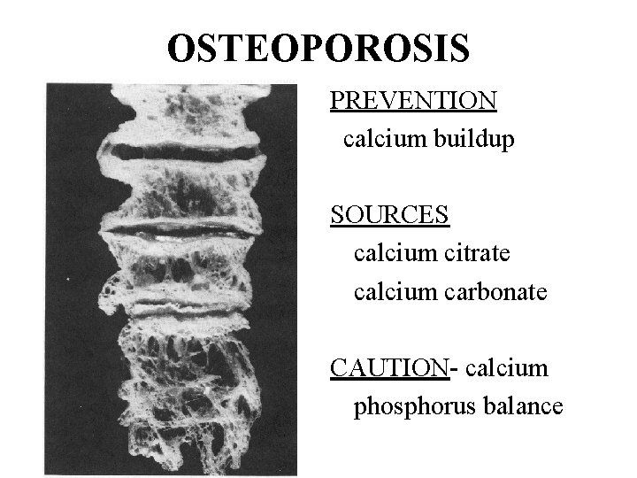 OSTEOPOROSIS PREVENTION calcium buildup SOURCES calcium citrate calcium carbonate CAUTION- calcium phosphorus balance 