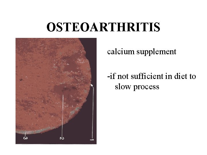 OSTEOARTHRITIS calcium supplement -if not sufficient in diet to slow process 