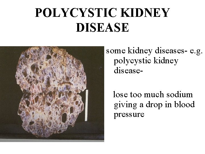 POLYCYSTIC KIDNEY DISEASE some kidney diseases- e. g. polycystic kidney disease- lose too much