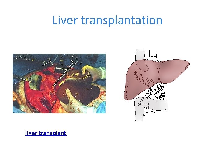 Liver transplantation liver transplant 