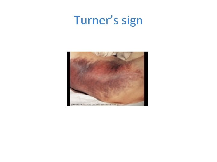 Turner’s sign 