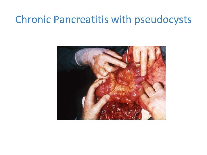 Chronic Pancreatitis with pseudocysts 