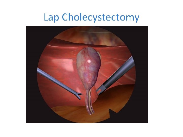 Lap Cholecystectomy 