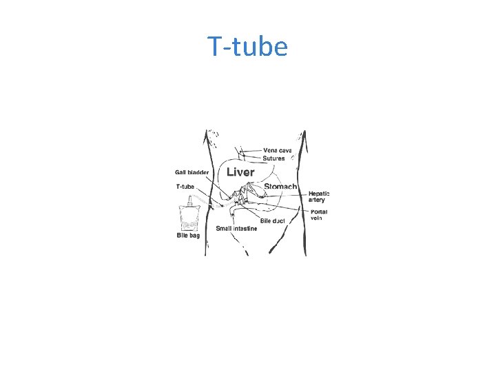 T-tube 