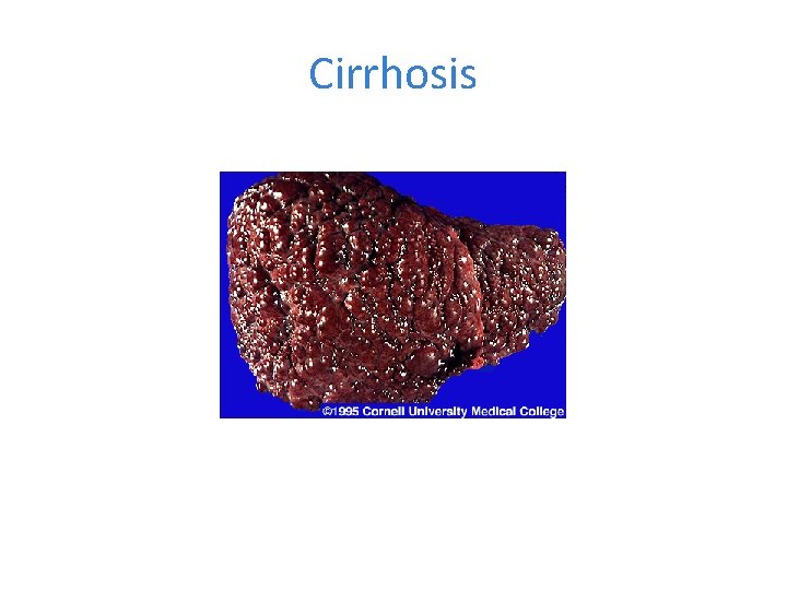 Cirrhosis 