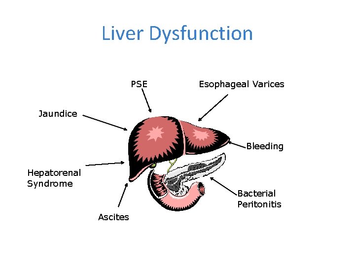 Liver Dysfunction PSE Esophageal Varices Jaundice Bleeding Hepatorenal Syndrome Bacterial Peritonitis Ascites 