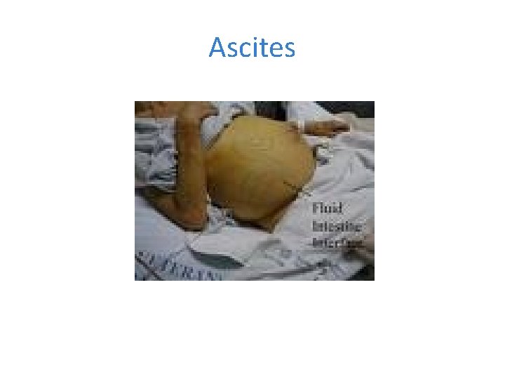 Ascites 