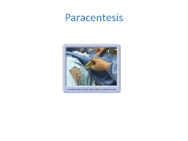 Paracentesis 