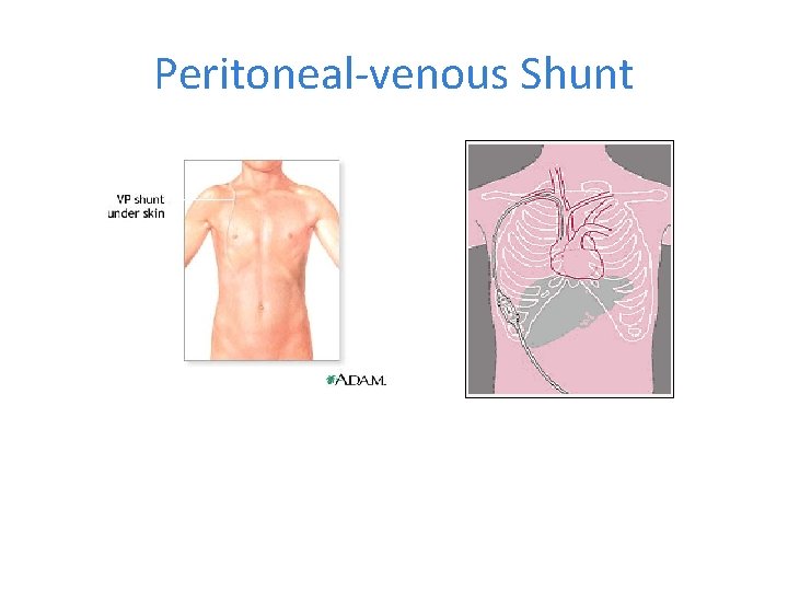 Peritoneal-venous Shunt 