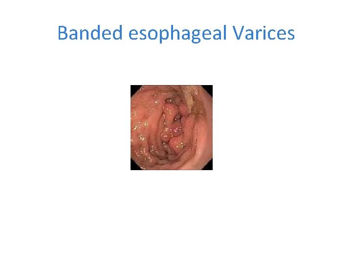 Banded esophageal Varices 