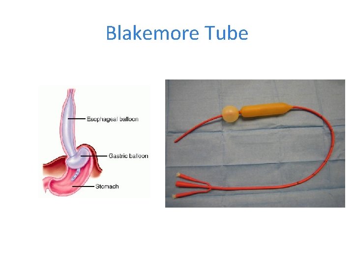 Blakemore Tube 