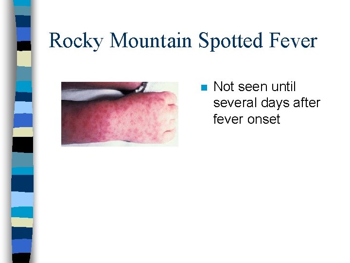 Rocky Mountain Spotted Fever n Not seen until several days after fever onset 