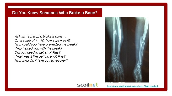 Do You Know Someone Who Broke a Bone? Ask someone who broke a bone…