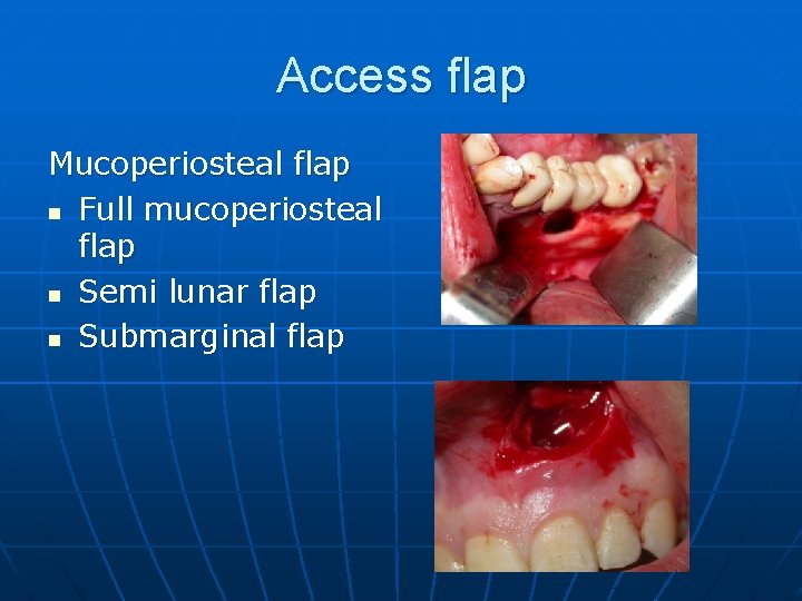 Access flap Mucoperiosteal flap n Full mucoperiosteal flap n Semi lunar flap n Submarginal