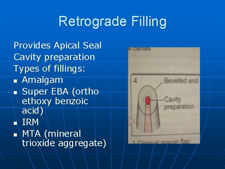 Retrograde Filling Provides Apical Seal Cavity preparation Types of fillings: n Amalgam n Super