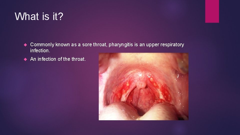 What is it? Commonly known as a sore throat, pharyngitis is an upper respiratory