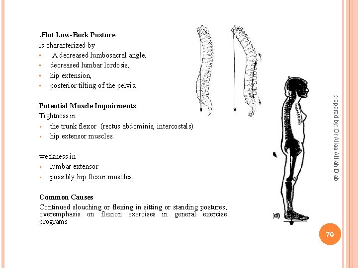 . Flat Low-Back Posture is characterized by • A decreased lumbosacral angle, • decreased