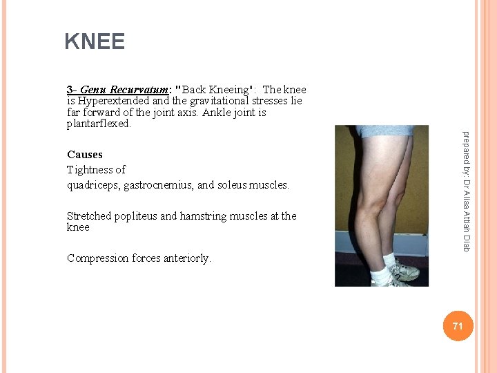 KNEE 3 - Genu Recurvatum: "Back Kneeing": The knee is Hyperextended and the gravitational