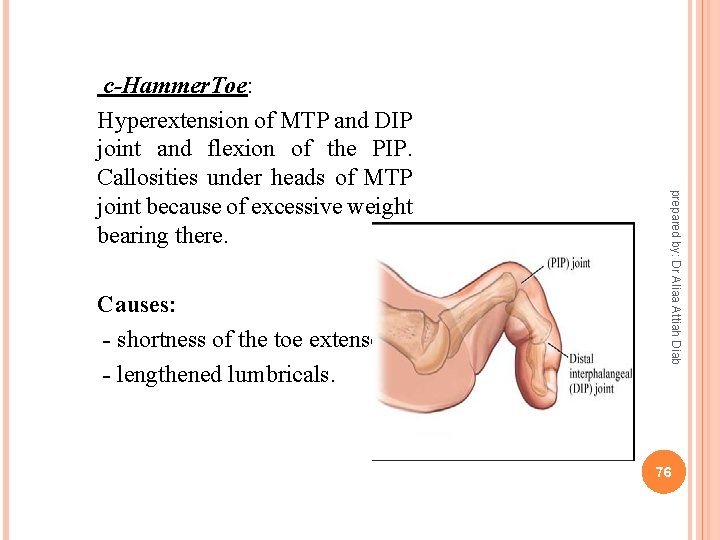 prepared by: Dr Aliaa Attiah Diab c-Hammer. Toe: Hyperextension of MTP and DIP joint