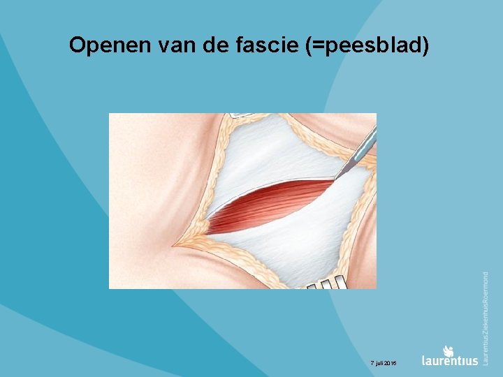 Openen van de fascie (=peesblad) 7 juli 2016 