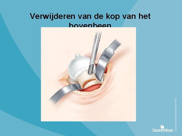 Verwijderen van de kop van het bovenbeen 