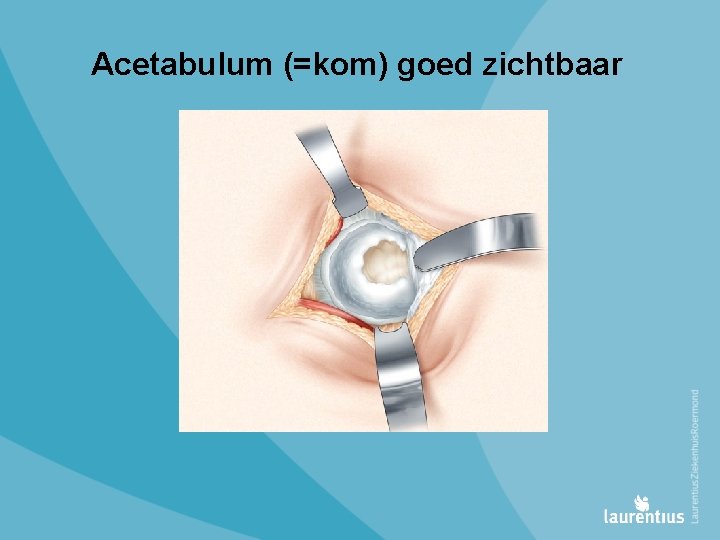 Acetabulum (=kom) goed zichtbaar 