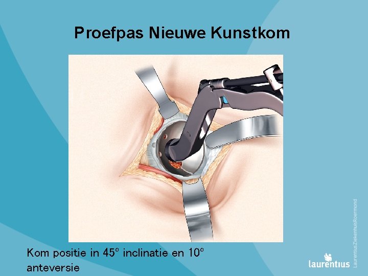 Proefpas Nieuwe Kunstkom Kom positie in 45º inclinatie en 10º anteversie 