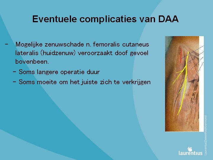 Eventuele complicaties van DAA - Mogelijke zenuwschade n. femoralis cutaneus lateralis (huidzenuw) veroorzaakt doof