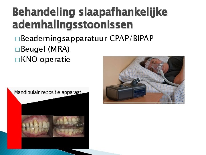 Behandeling slaapafhankelijke ademhalingsstoonissen � Beademingsapparatuur � Beugel (MRA) � KNO operatie CPAP/BIPAP 