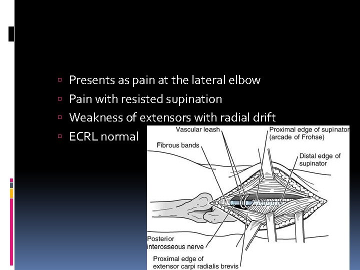  Presents as pain at the lateral elbow Pain with resisted supination Weakness of