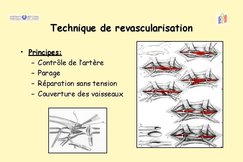 Technique de revascularisation • Principes: – Contrôle de l’artère – Parage – Réparation sans