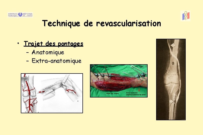 Technique de revascularisation • Trajet des pontages – Anatomique – Extra-anatomique 