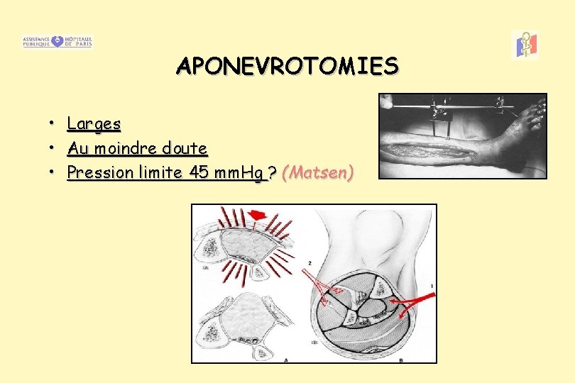 APONEVROTOMIES • • • Larges Au moindre doute Pression limite 45 mm. Hg ?