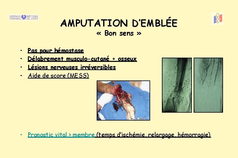 AMPUTATION D’EMBLÉE « Bon sens » • • Pas pour hémostase Délabrement musculo-cutané +