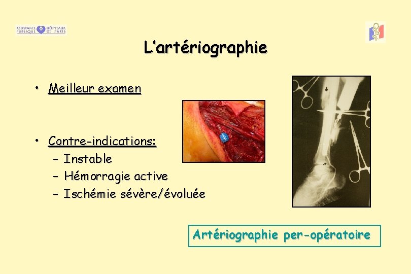 L’artériographie • Meilleur examen • Contre-indications: – Instable – Hémorragie active – Ischémie sévère/évoluée