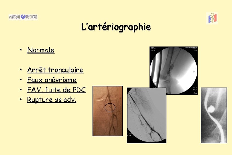 L’artériographie • Normale • • Arrêt tronculaire Faux anévrisme FAV, fuite de PDC Rupture