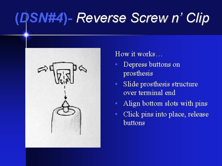(DSN#4)- Reverse Screw n’ Clip How it works… • Depress buttons on prosthesis •