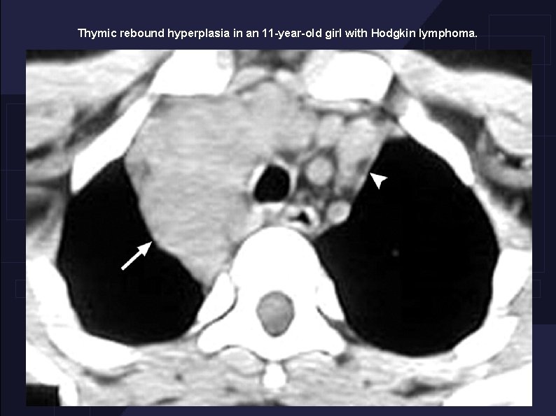 Thymic rebound hyperplasia in an 11 -year-old girl with Hodgkin lymphoma. 