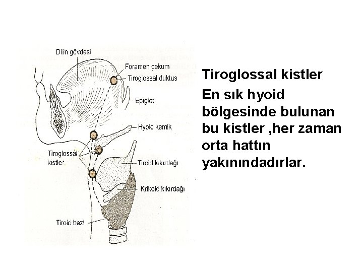  • Tiroglossal kistler • En sık hyoid bölgesinde bulunan bu kistler , her