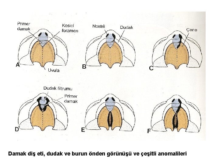 Damak diş eti, dudak ve burun önden görünüşü ve çeşitli anomalileri 