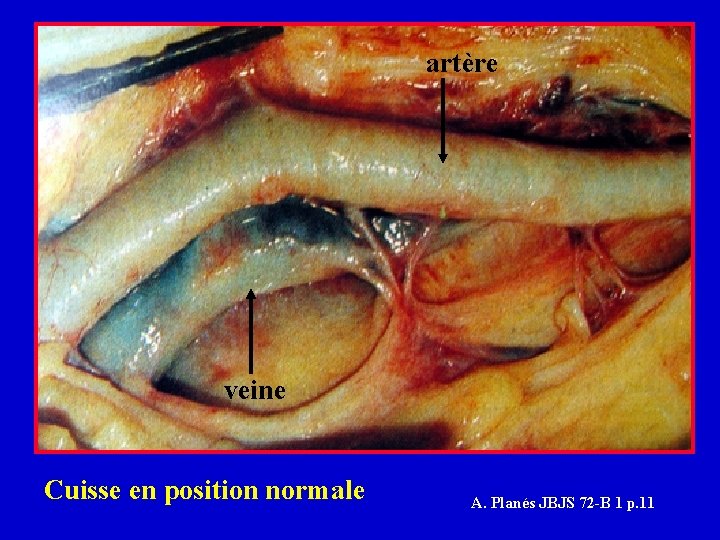 artère veine Cuisse en position normale A. Planés JBJS 72 -B 1 p. 11