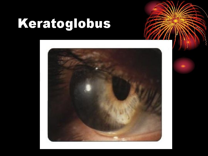 Keratoglobus 