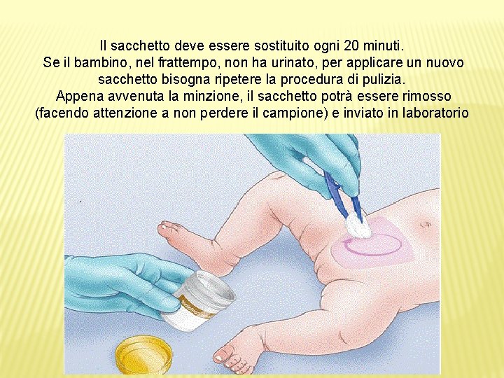 Il sacchetto deve essere sostituito ogni 20 minuti. Se il bambino, nel frattempo, non